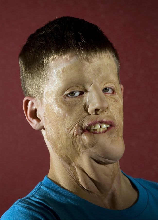 Mitch Hunter was left looking unrecognisable after he bravely put his life on the line