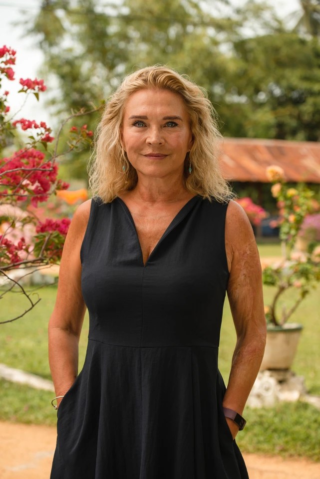 Amanda Redman has a badly scarred arm, thanks to an accident as a baby