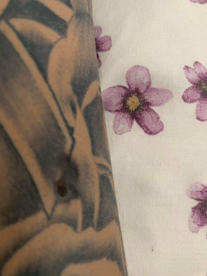 Tom’s tattoo artist noticed a mole on his arm at the age of 18 years old