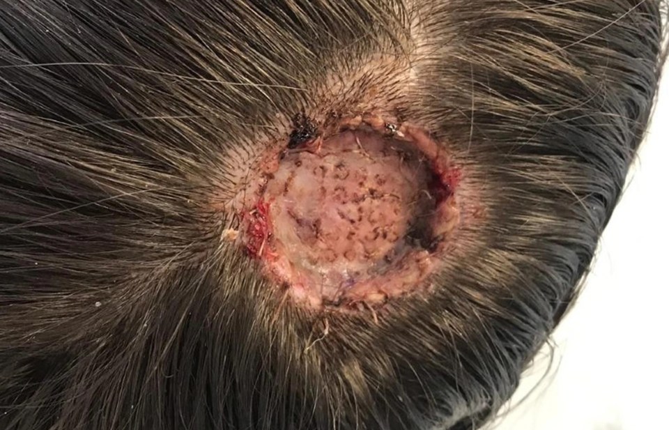 Nickie had to have the lump removed and it has left her with a huge crater-shaped whole in her head