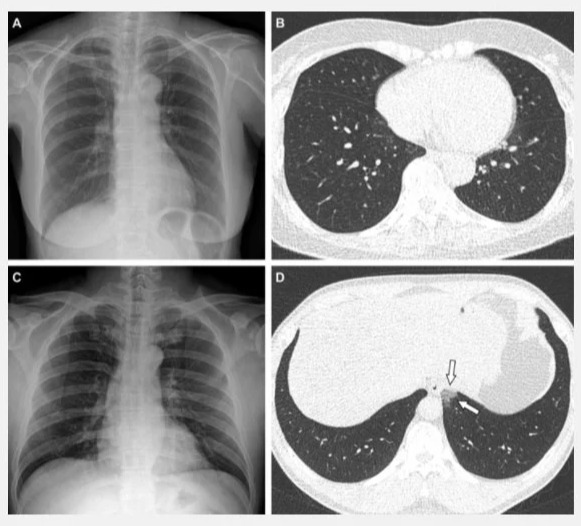 Images A&B (top left and right) show the lung scans of a woman who had two doses of the Pfizer/BioNTech vaccine, with no clouding on the lungs. Images C&D bottom left and right show lung scans of a patient who had just one dose of the AstraZeneca vaccine, image D shows the small amount of clouding in the lung, with experts finding a small presence of pneumonia