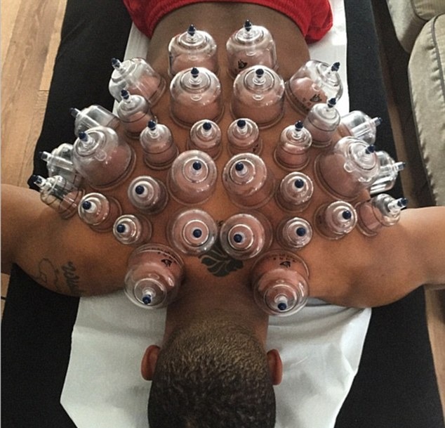 Cupping has become all the rage amongst fighters, with the likes of Anthony Joshua using the treatment