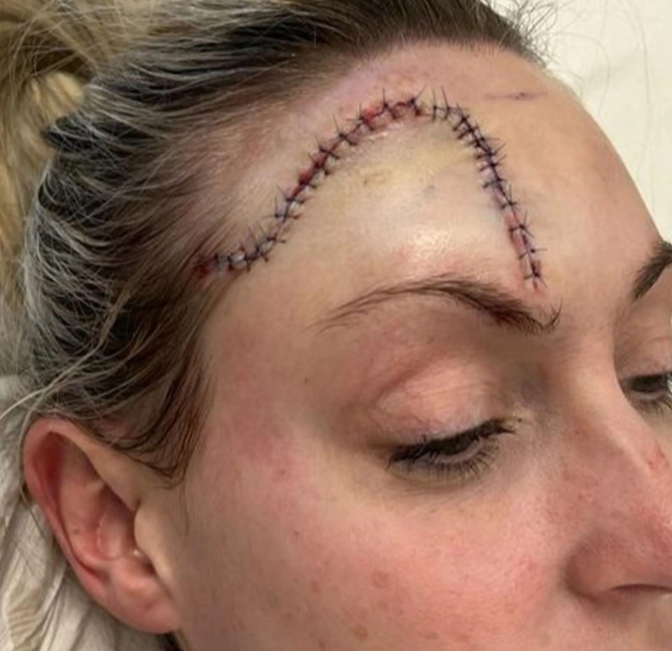 Rachael has now been left with a large scar on her head after having the surgery to remove the skin cancer