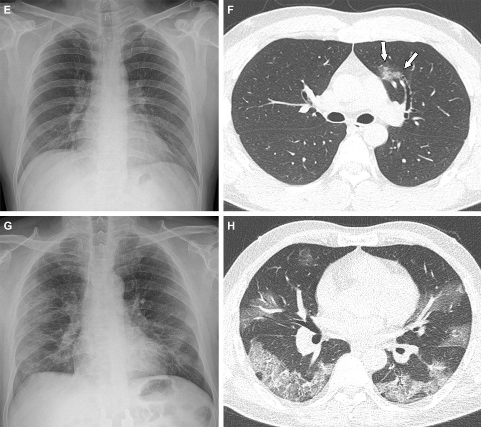 Lung scans E&F (top left and right) show a 36-year-old man with no vaccines, with arrows on scan F showing clouding of the lungs. Scans G&H (bottom left and right) are from a 58-year-old man with no vaccines who required supplemental oxygen on admission and was admitted to intensive care unit one day later