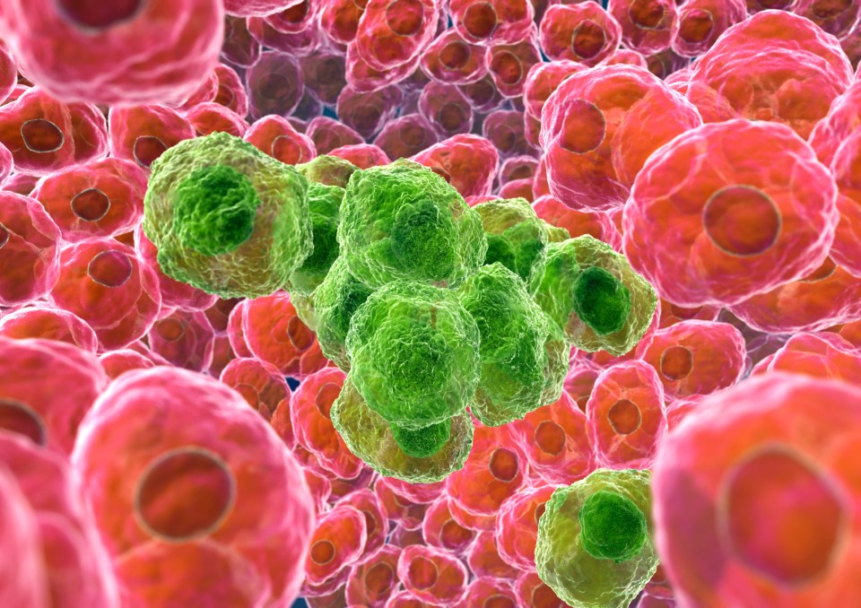 Cancerous cells (green) infecting healthy tissue