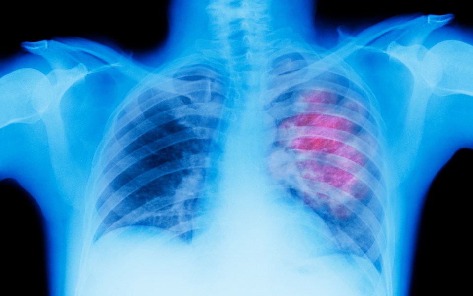 Lung cancer mainly affects older people and it’s rare in old people