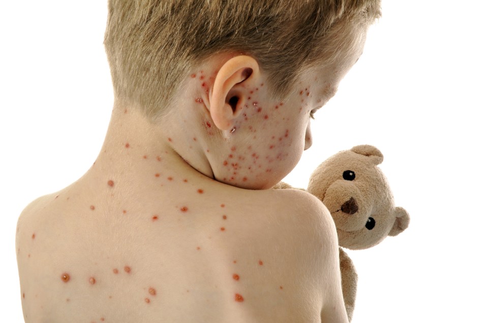  Chickenpox can be uncomfortable and it's most common in children