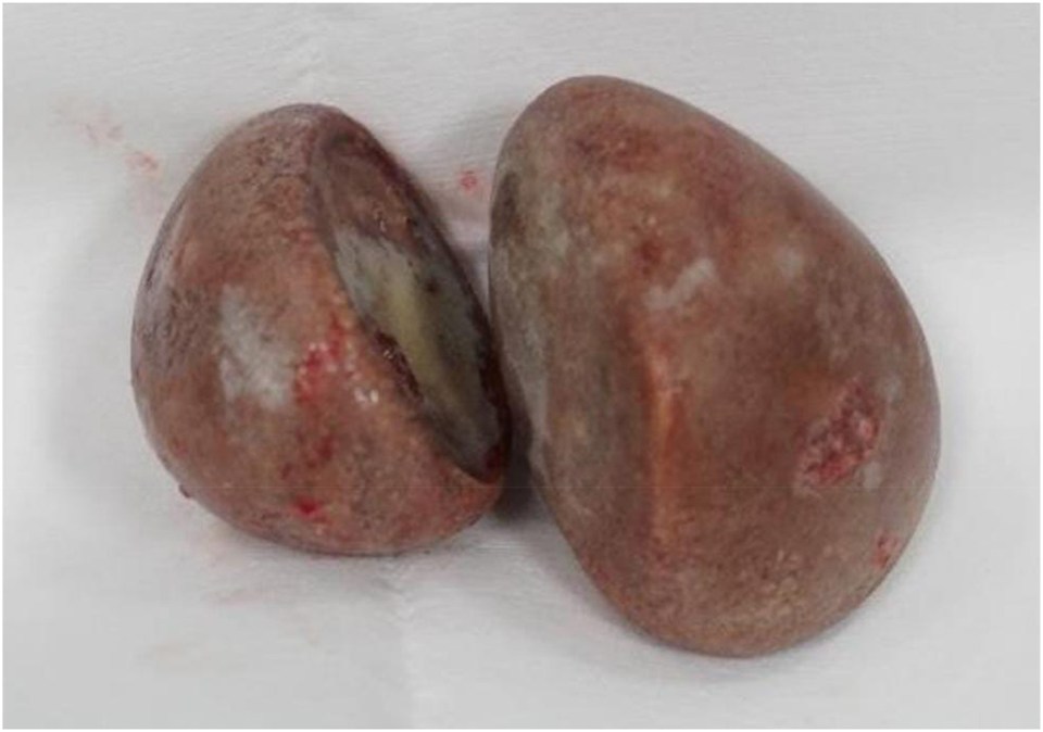 The vaginal stones, about the size of ping-pong balls, after removal from the woman's vagina