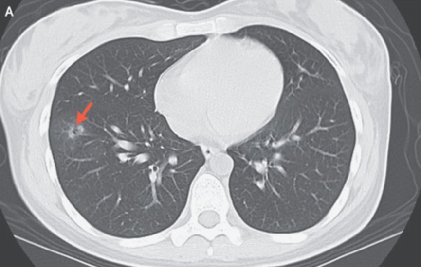 A collection of endometrial tissue was found in the woman's lung in a rare case