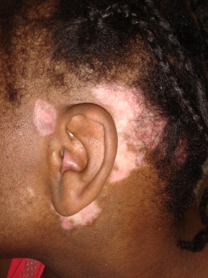 Kelle developed ulcers on her face, ears, arms and scalp