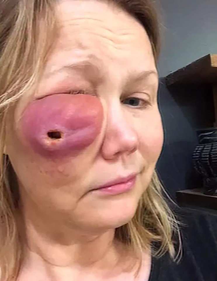 Doctor Gina Anderson was left with a granuloma after having silicone injected into her cheeks