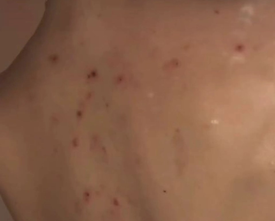 Because of the incessant scratching she was left with what looked like 'chickenpox'