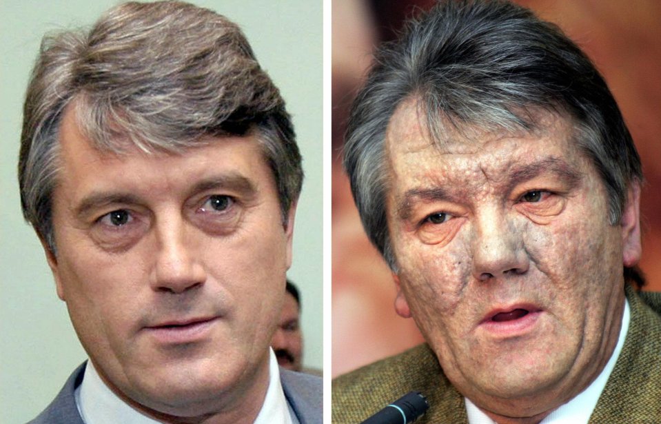 Viktor Yushchenko, the former Ukrainian president, suffered dioxin poisoning in 2004