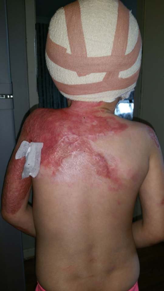 Horrific burns from the oil meant Grace had to get skin grafts every other day