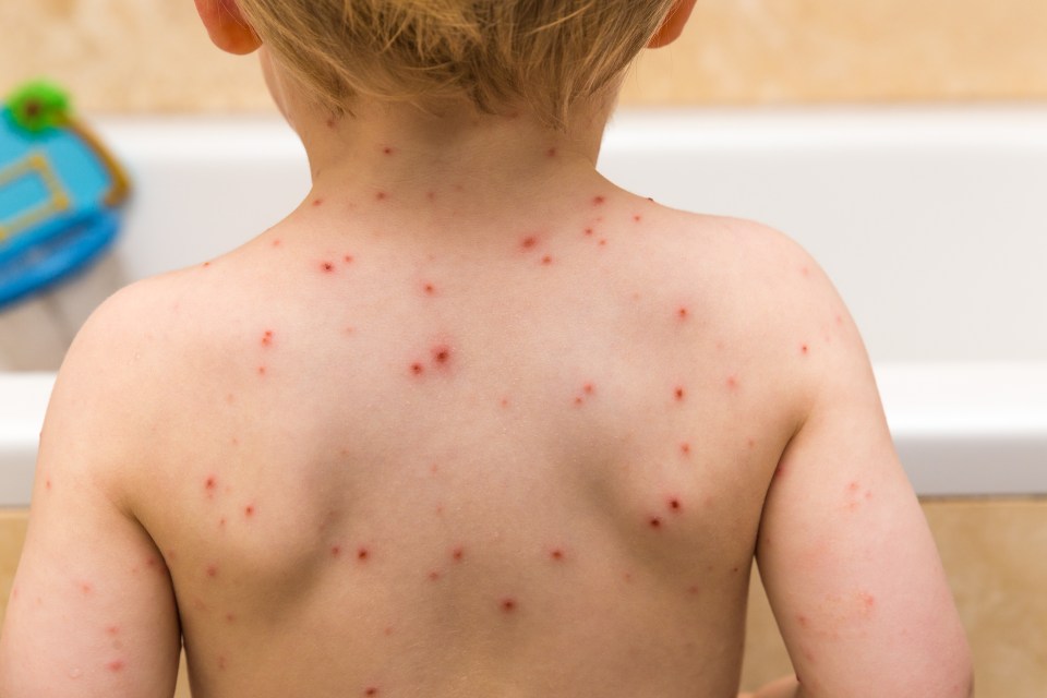 Chickenpox is a common childhood illness, but one doctor has revealed the mistakes that parents could be making