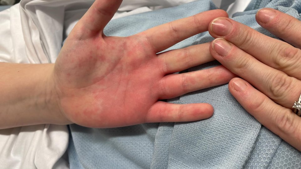 Children with the condition often have rashes on their limbs