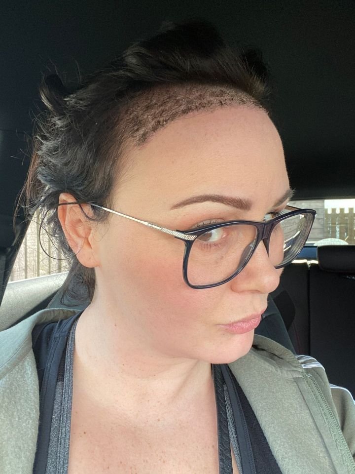 Chanelle shows off the hair transplant as her new locks start to grow - filling her with new confidence