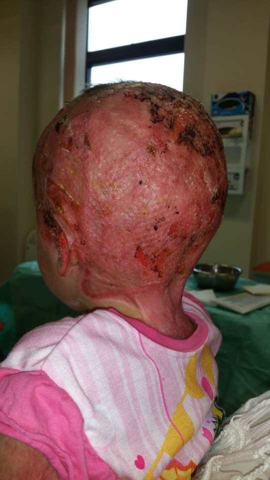 Grace had horrific burns to her head following the accident