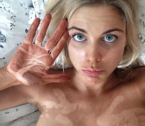 Ashley shared this snap - proving even she is prone to a tanning disaster