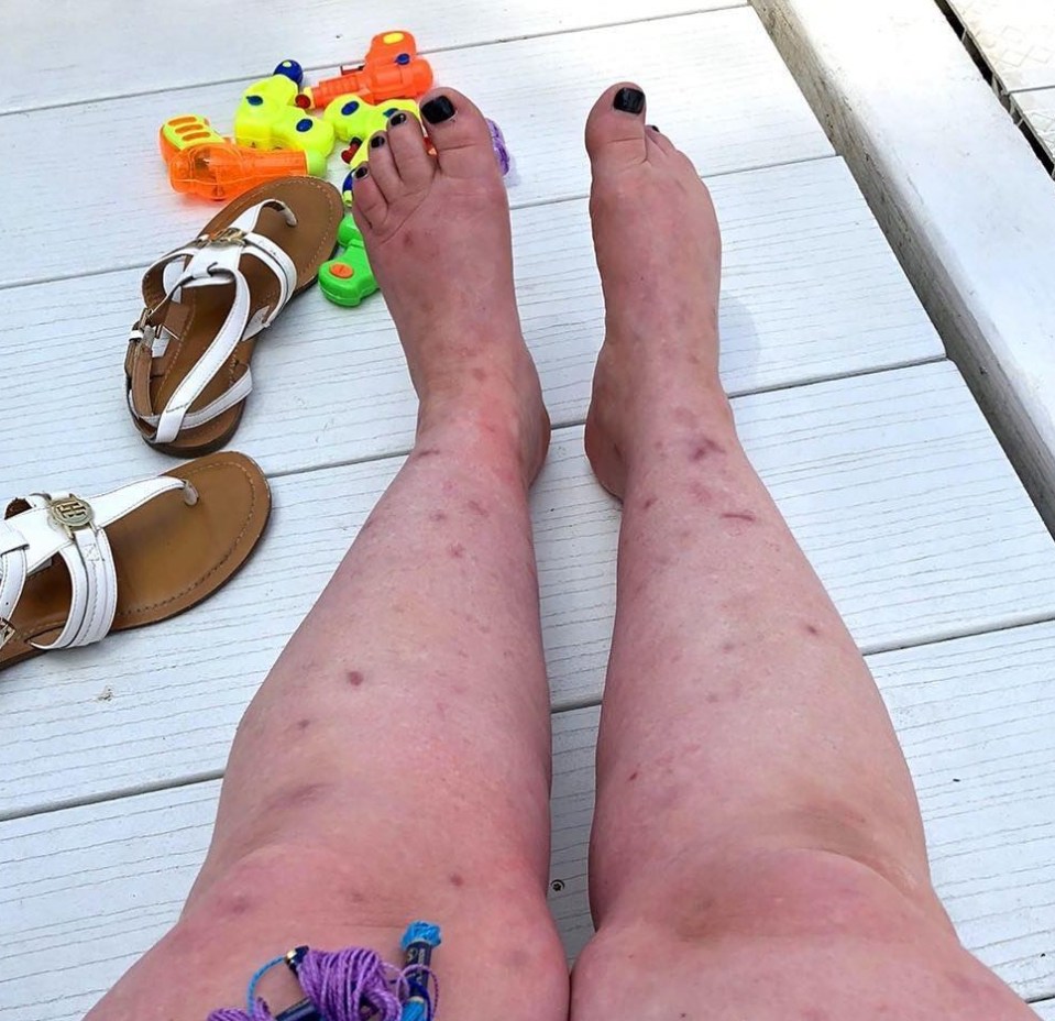 Lauren can't help her habit, and in 2014, it led to bacteria entering a wound on her leg and causing a gruesome infection. Pictured are the marks she has on her legs due to her condition