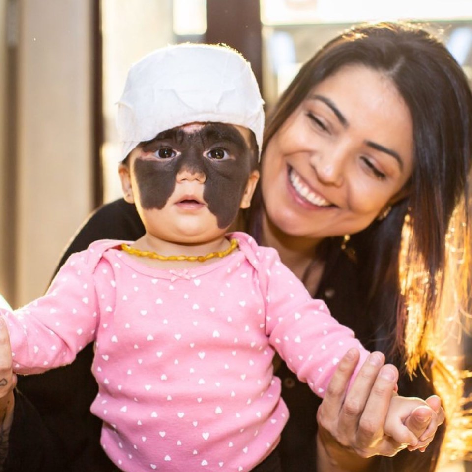 Luna Tavares-Fenner, three, after she was given her first surgery