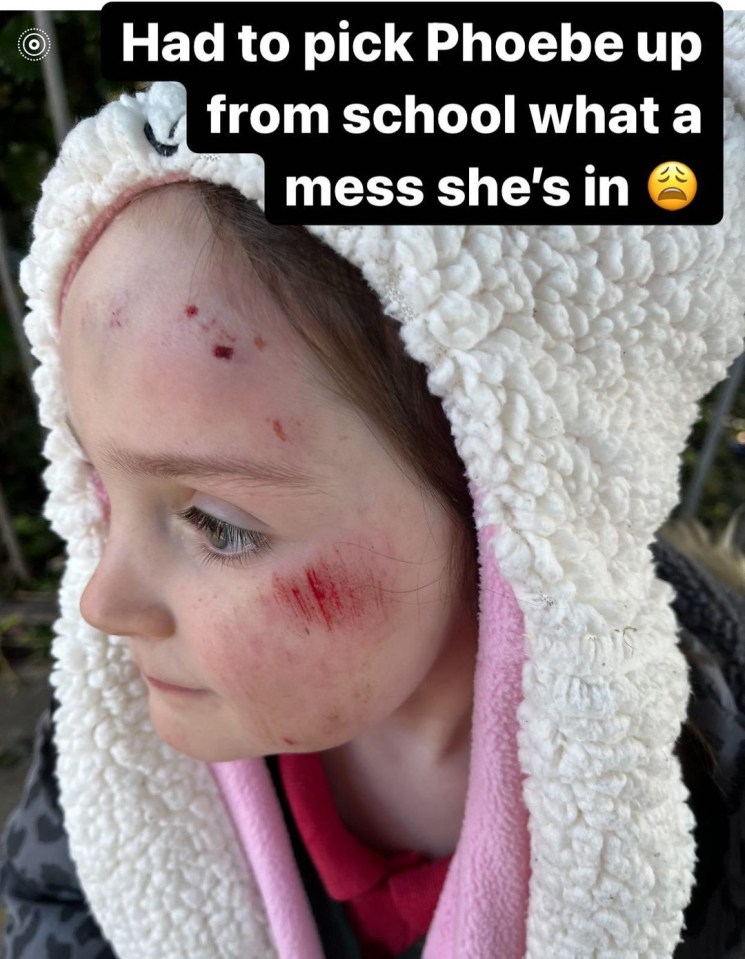 Mum-of-22 Sue Radford showed off daughter Phoebe's face after she tripped over in the school playground