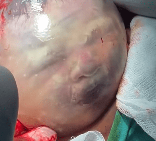 The video shows a baby's face moving found in an amniotic sac which is full of fluid