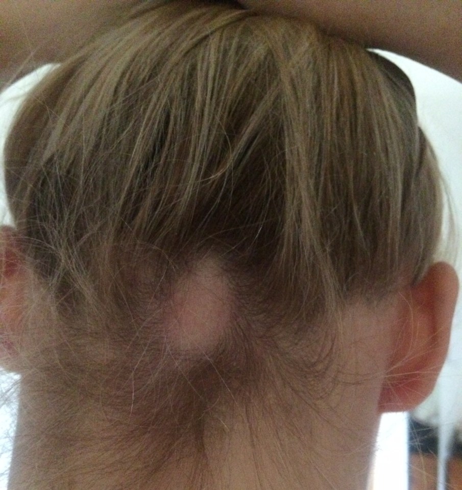 A hairdresser told Chloe in February 2017 that she had a small bald patch on her scalp