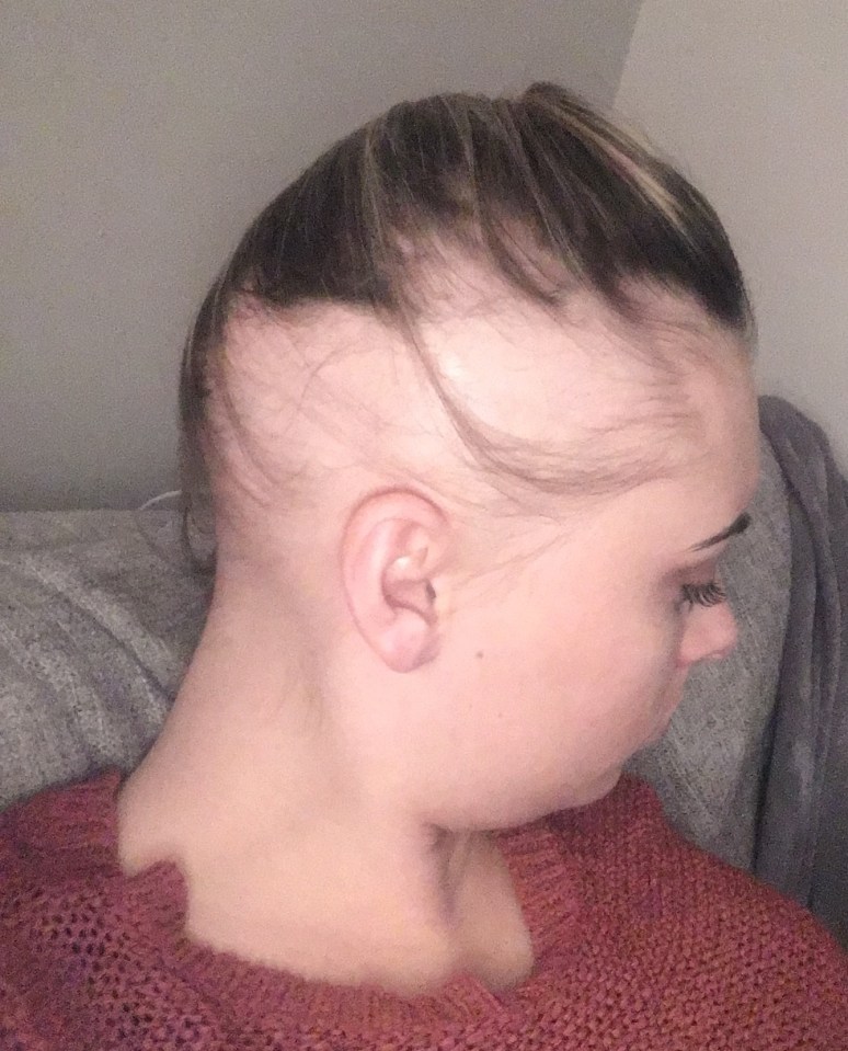 Chloe Sheehan suddenly lost her hair due to alopecia - which she believes was triggered by a smear test and procedures following it