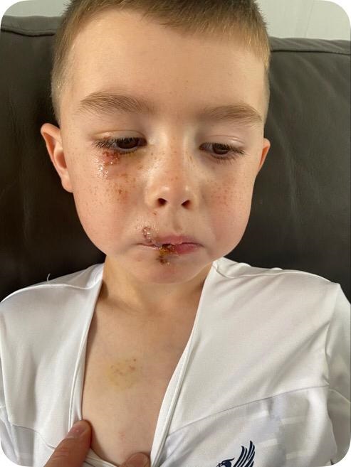 A four-year-old boy suffered shocking facial injuries after he was attacked by a lurcher as he went to use the toilet