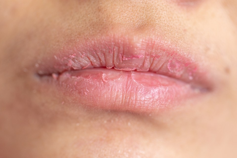 So-called fluffy lips are common and there are many causes for the condition