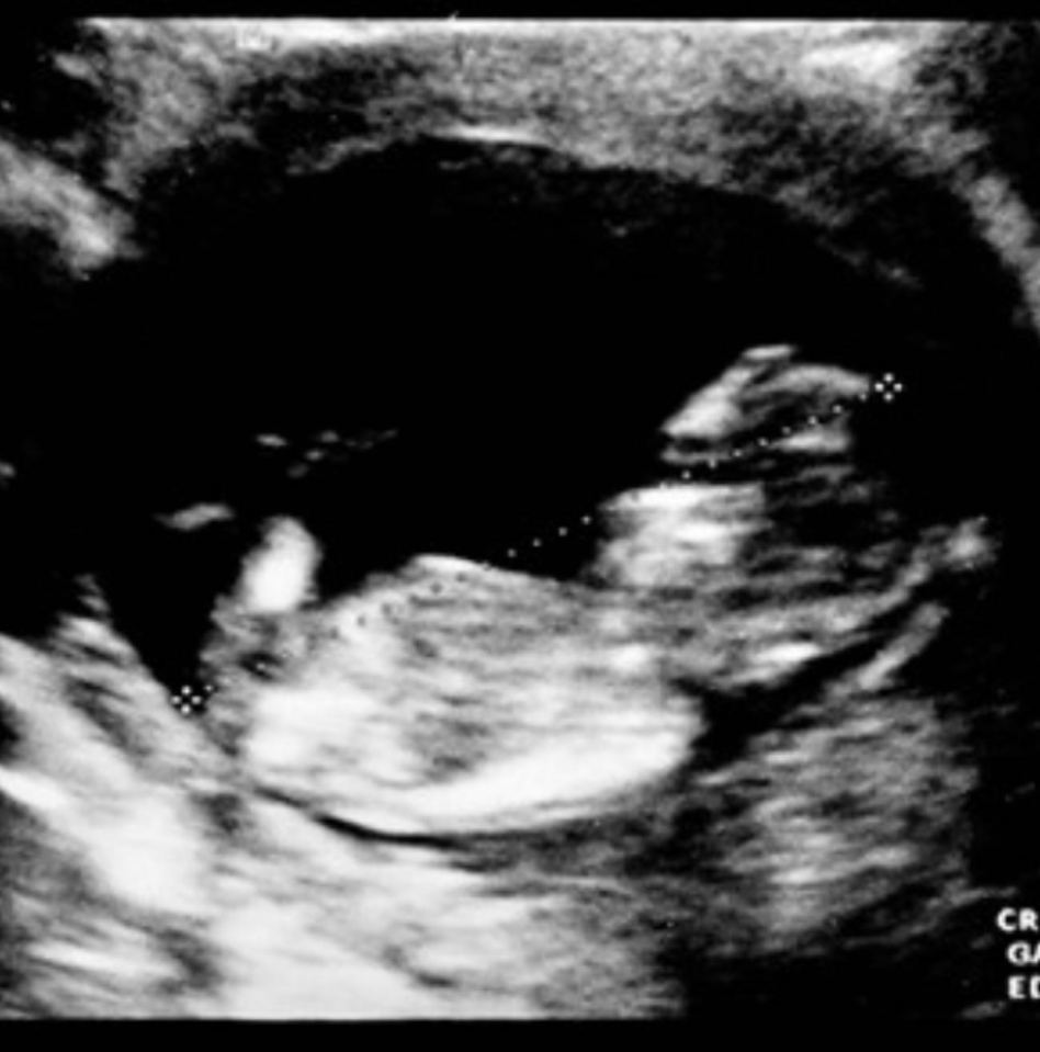 She shared this ultrasound snap saying she was pregnant