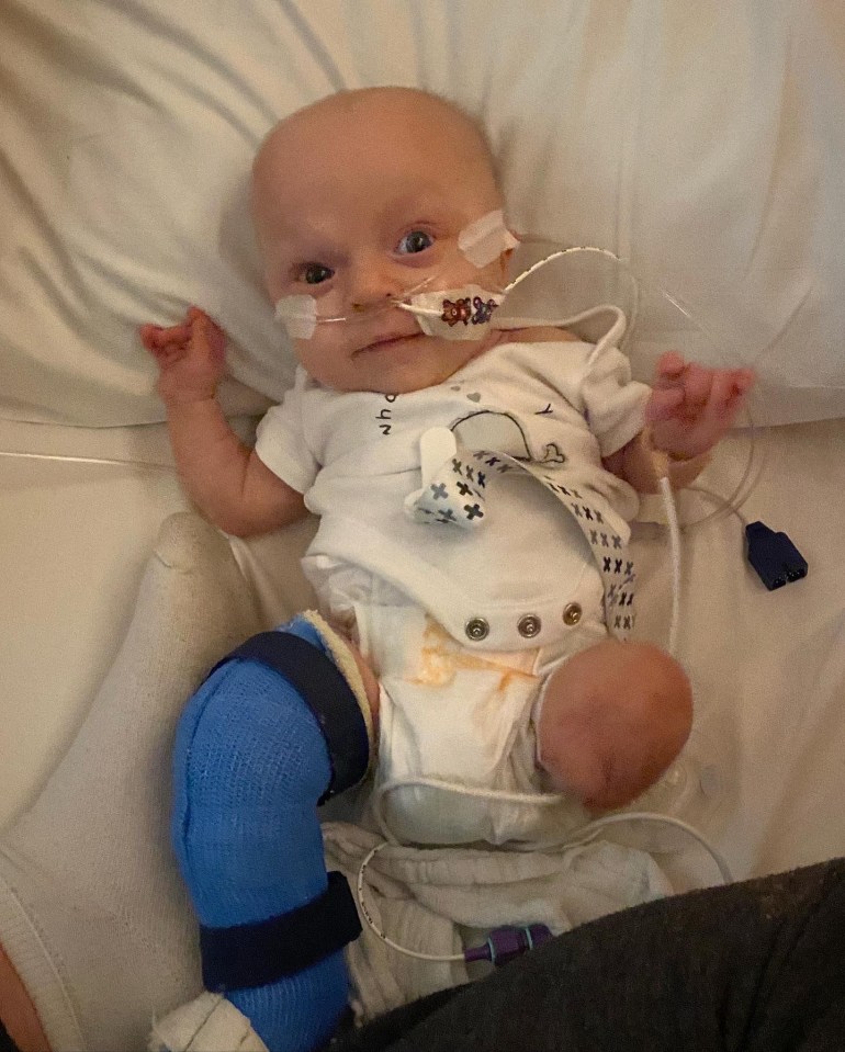 Mason managed to recover from a rare infection, five life-saving surgeries, a brain bleed and the amputation of his left leg