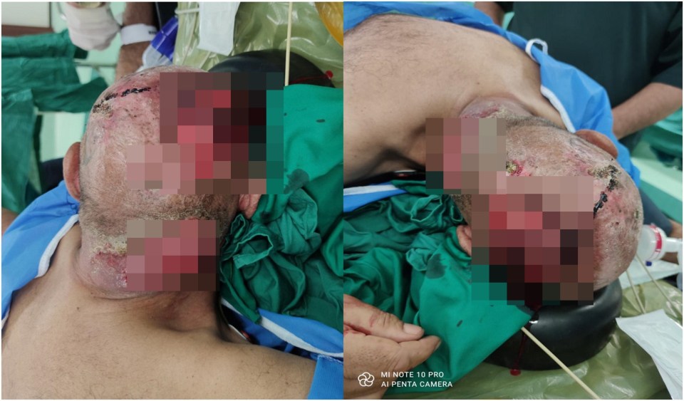 Doctors shared shocking photos of a man’s scalp destroyed by cancer. He is pictured before having surgery