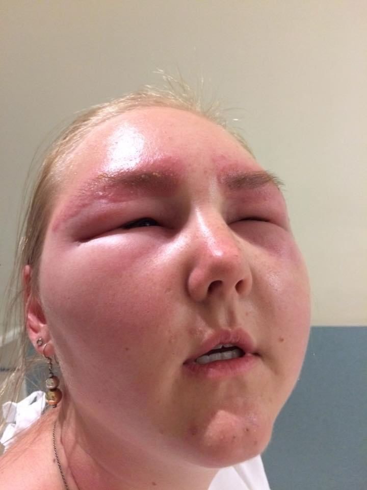 According to the 30-year-old, kids were scared of her once the brutal allergic reaction had kicked in