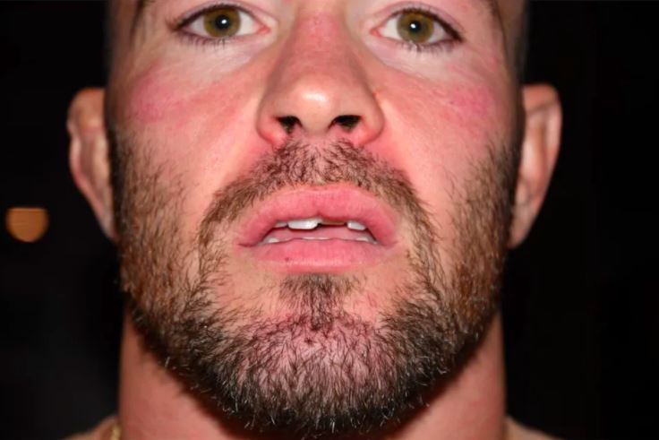 Colby Covington suffered a chipped tooth as a result of Jorge Masvidal's alleged attack