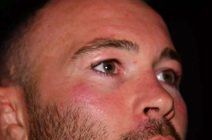 The former interim UFC welterweight champion also suffered additional facial injuries