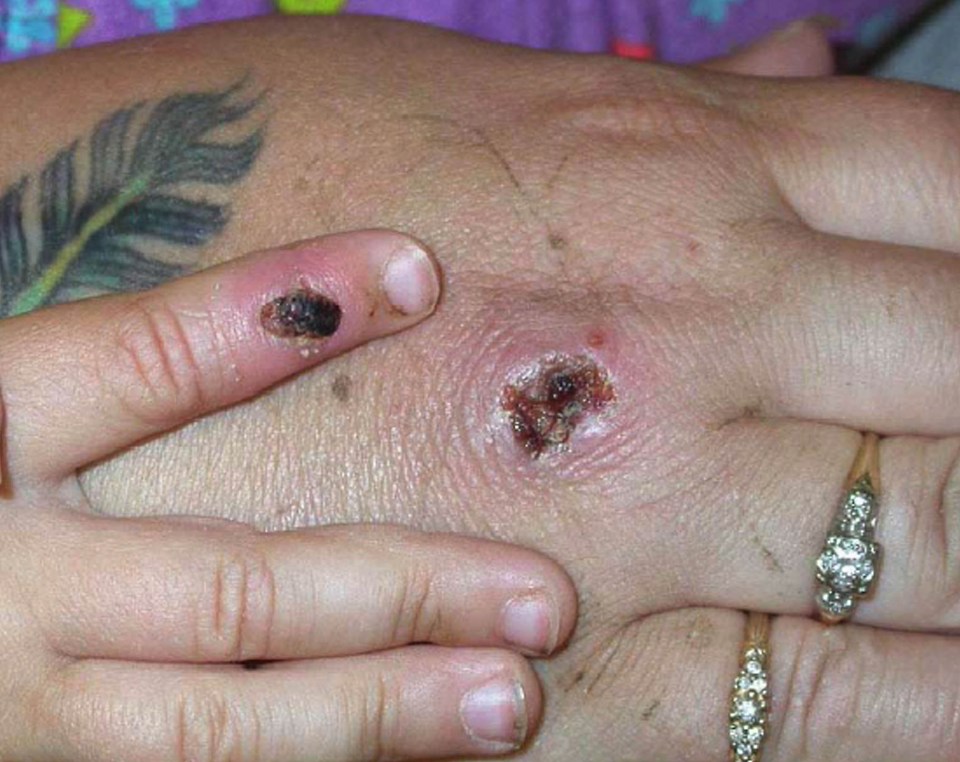 The lesions scab over. Once these scabs are fallen off, a person is no longer contagious