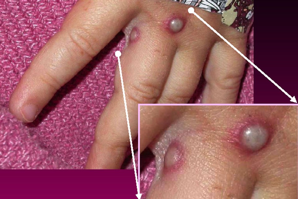 An example of how monkeypox causes lesions filled with pus, in this case large blisters on a child's hand