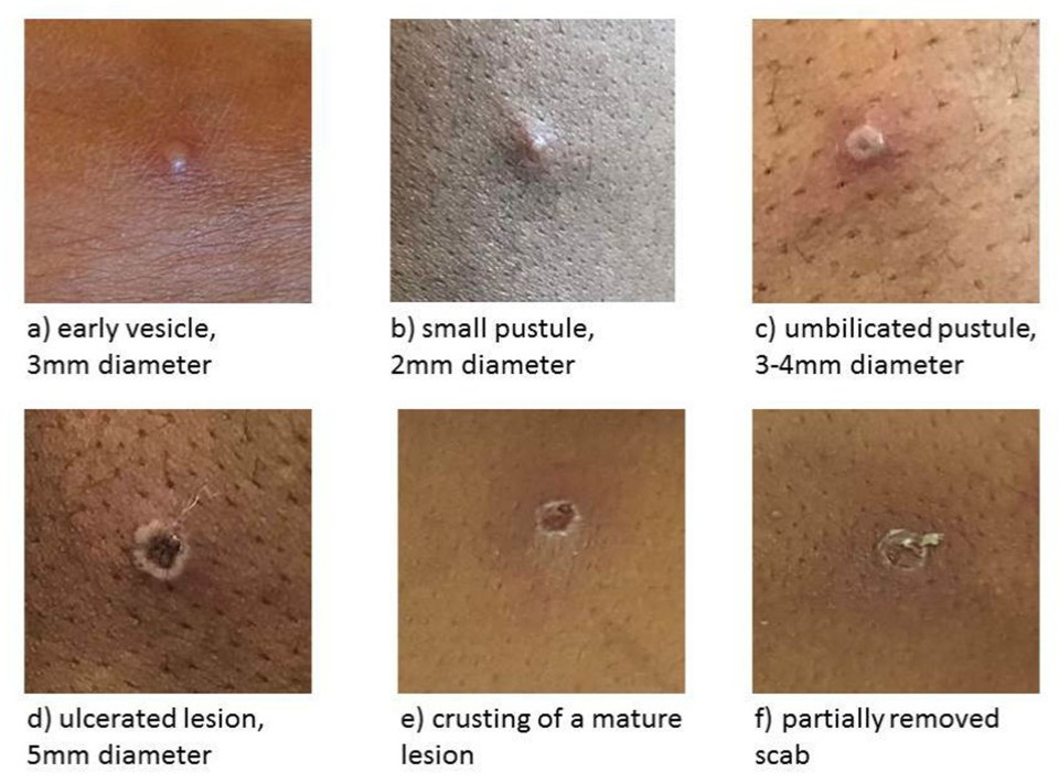 A: Vesicle (blister with clear fluid). B: Pustle (yellow-filled pus blister). C: Pustule with an indent. D-F: The ulcerated and crusting of the lesion, leading to a scab falling off