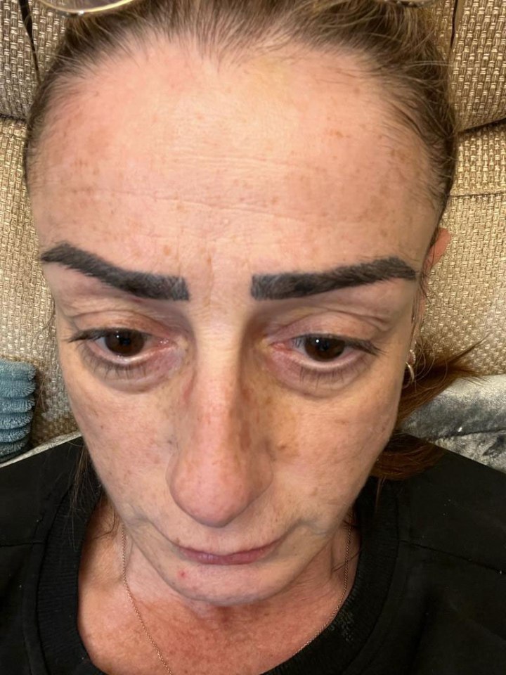 Debbie was left with "thick black blocks" on her face. Pictured, with botched brows