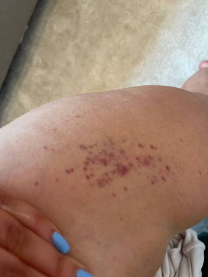 The itchy rash which appeared on Paris’ leg