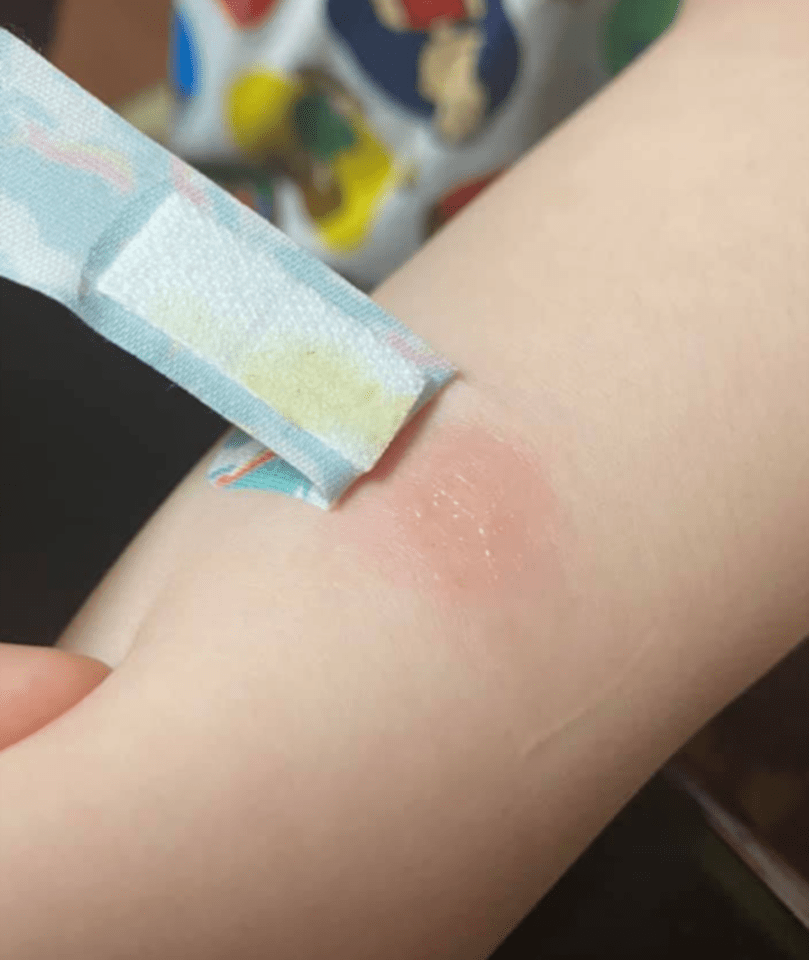 The explosion left a burn on the youngster's forearm