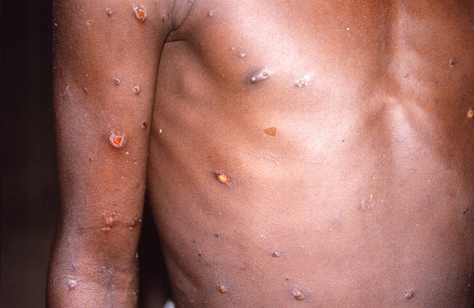 Monkeypox could be infectious for up to four weeks, an expert has claimed