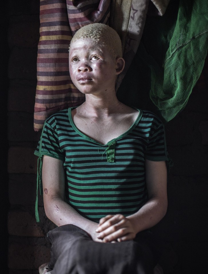 More than 170 albinos have been killed or maimed in similar attacks since 2014