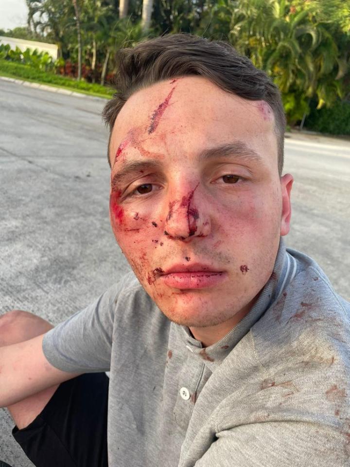 Lewis Morgan pictured the morning after he suffered horror injuries in Mexico