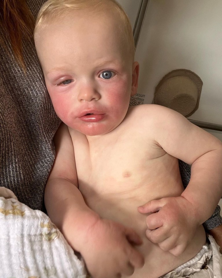 Binky Felstead last night revealed her little boy Wolfie had an allergic reaction