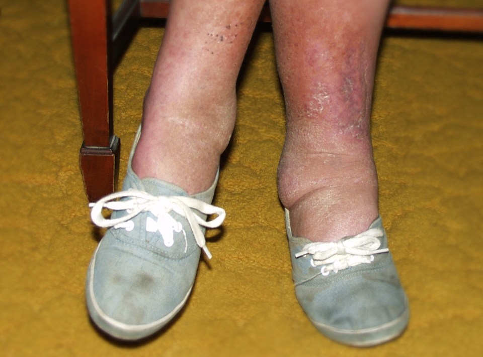 Your shoes or socks being tight around your ankles, as above, could be down to oedema