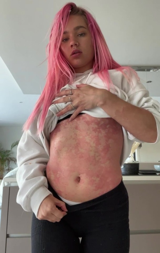 Rosie Daniels has such bad psoriasis that it feels as though her skin is sunburned all the time