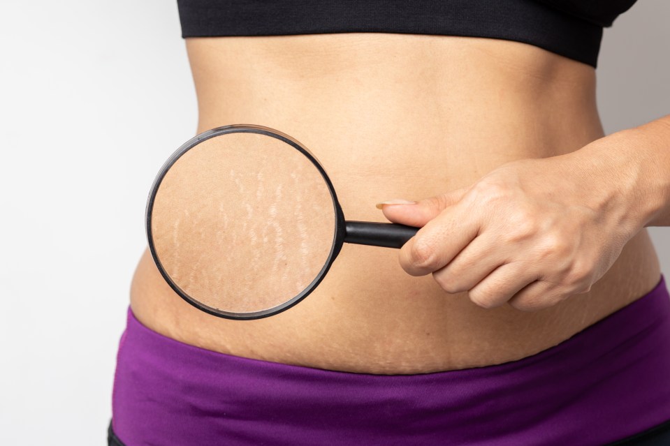 Stretch marks are a common change to the body that happen due to weight gain, but the severity of them has a lot to do with your genetic make up